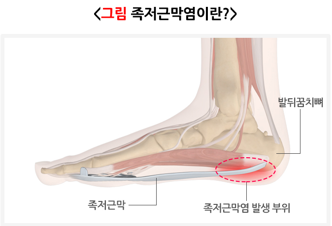 족저그막염 관련 이미지