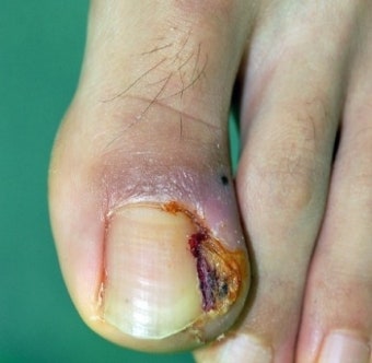 발톱 색 변색의 5가지 주요 원인