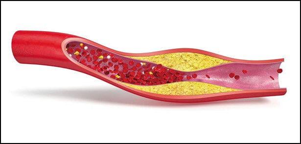 콜레스테롤이 쌓인 혈관