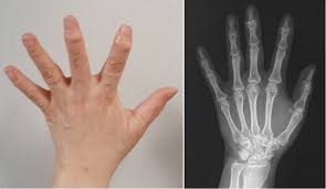 손가락 관절염 초기증상