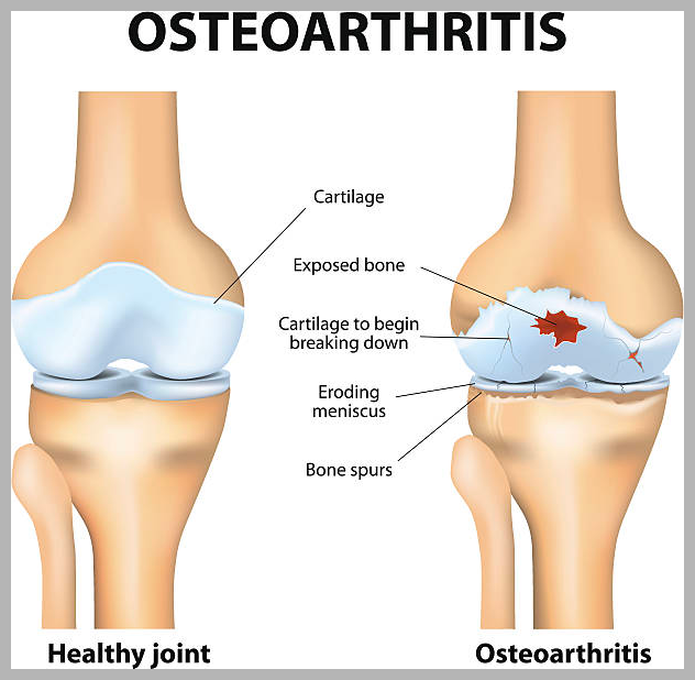 연골연화증 정상 비정상 차이
