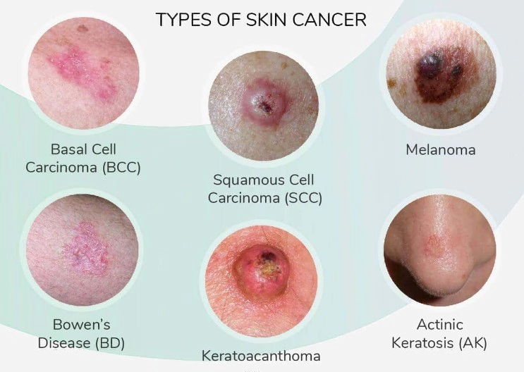 피부암 종류별 초기증상 10가지