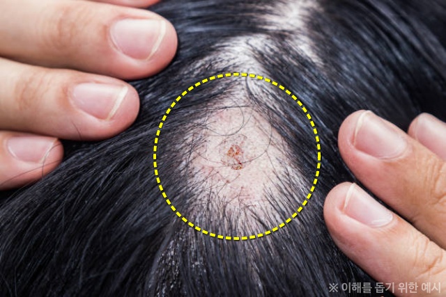 머리 딱지, 비듬, 지루성피부염, 건강 팁줌 매일꿀정보