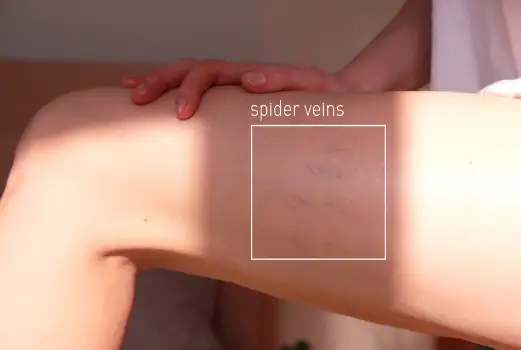 하지정맥류 초기 증상과 원인 치료방법