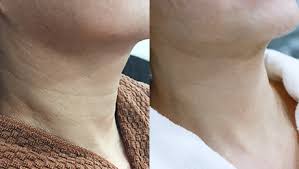 목주름 없애는 비결