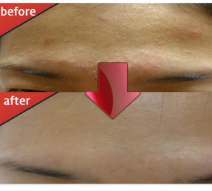 좁쌀 여드름 없애기