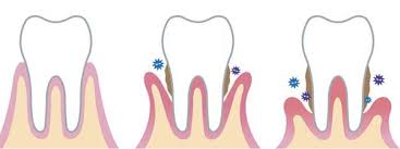 잇몸 염증 치료약