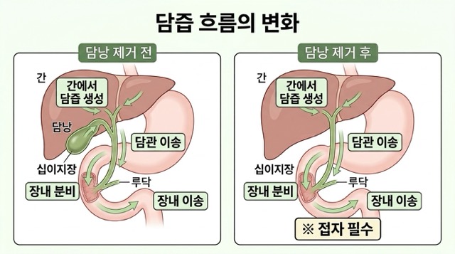담낭 제거 후 설사 복부통증 소화불량 피로감