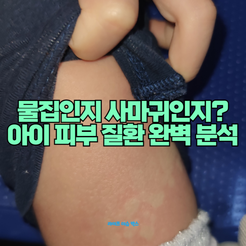 아이 다리에 물집이?