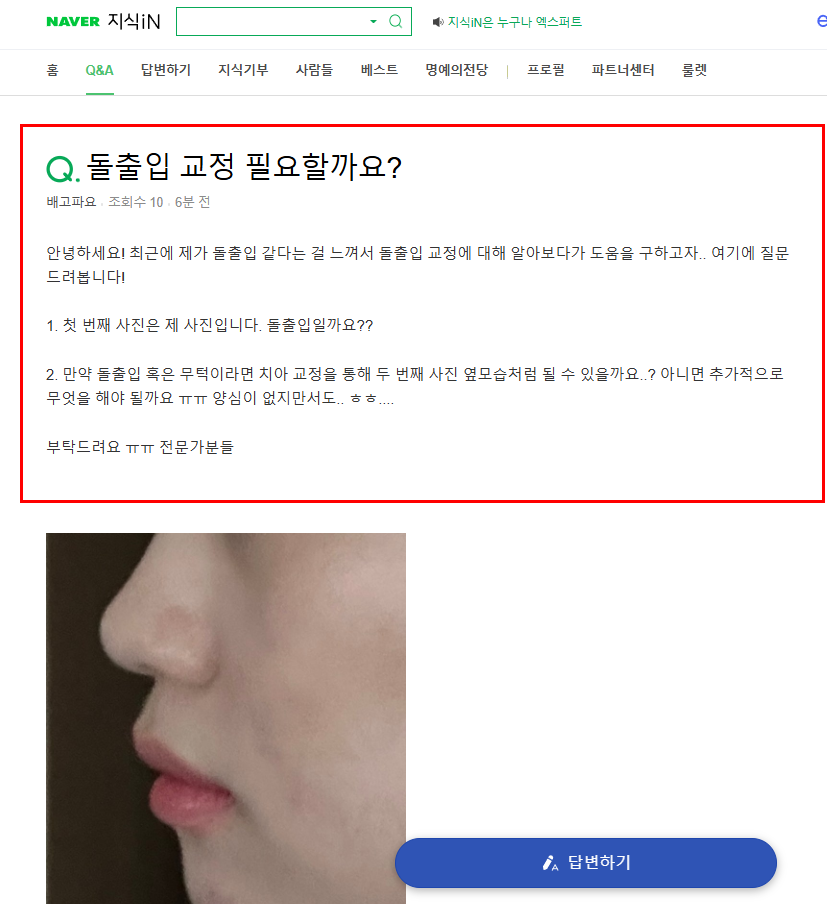 돌출입 교정 질문