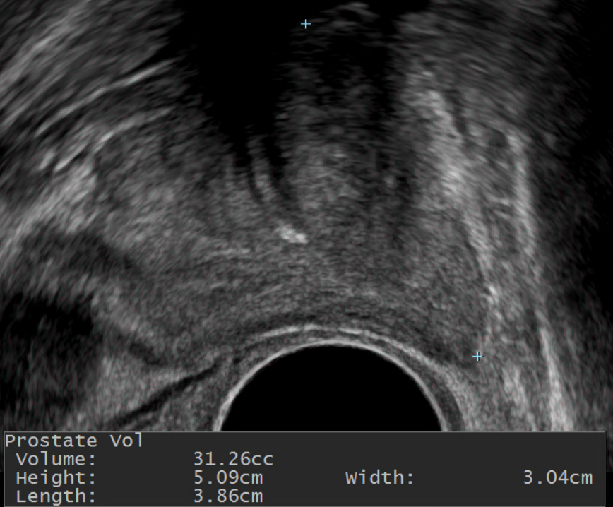 양성 전립선 비대증