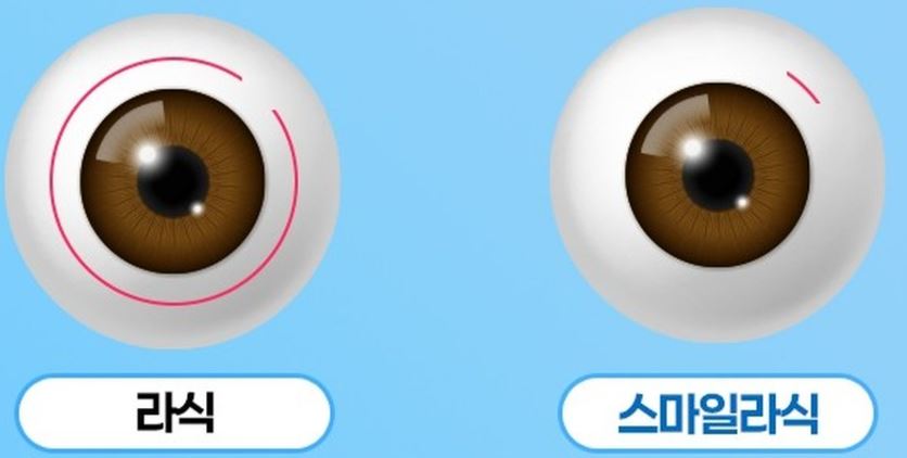 스마일라식 회복기간 가격 수술법 ❘ 부작용 주의점 ❘ 라섹 라식 비교