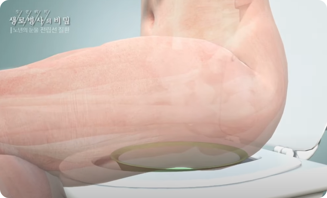 전립선좌욕사진