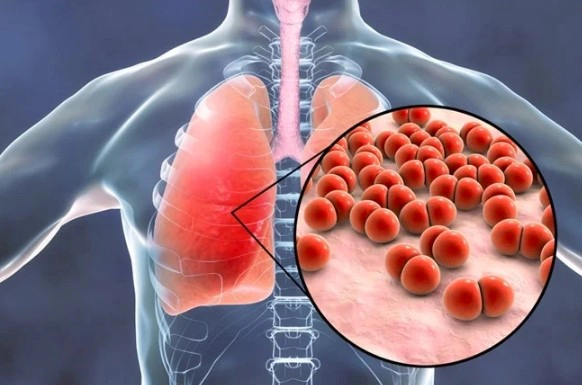 폐렴 초기증상 4가지