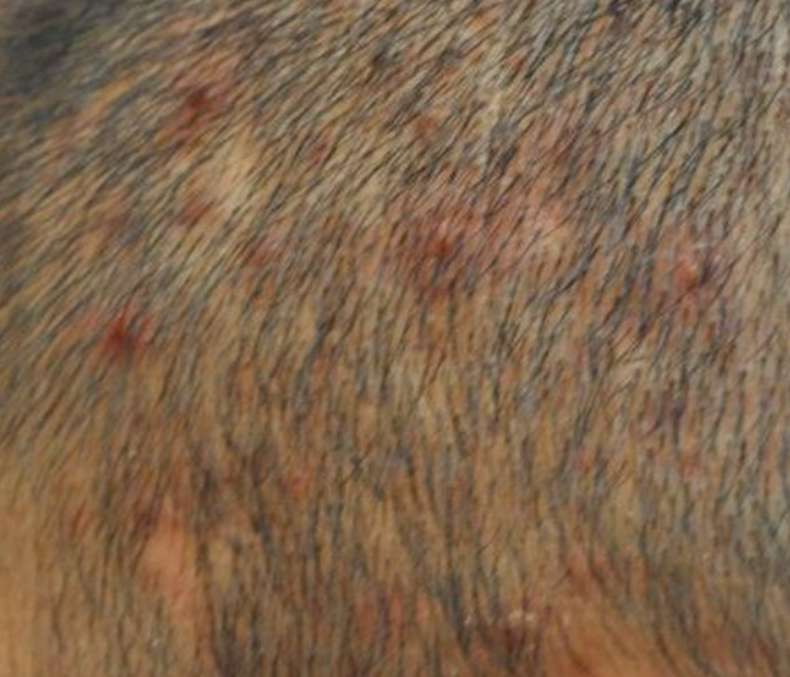 두피가려움증염증