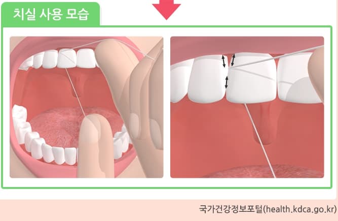 치실-사용법
