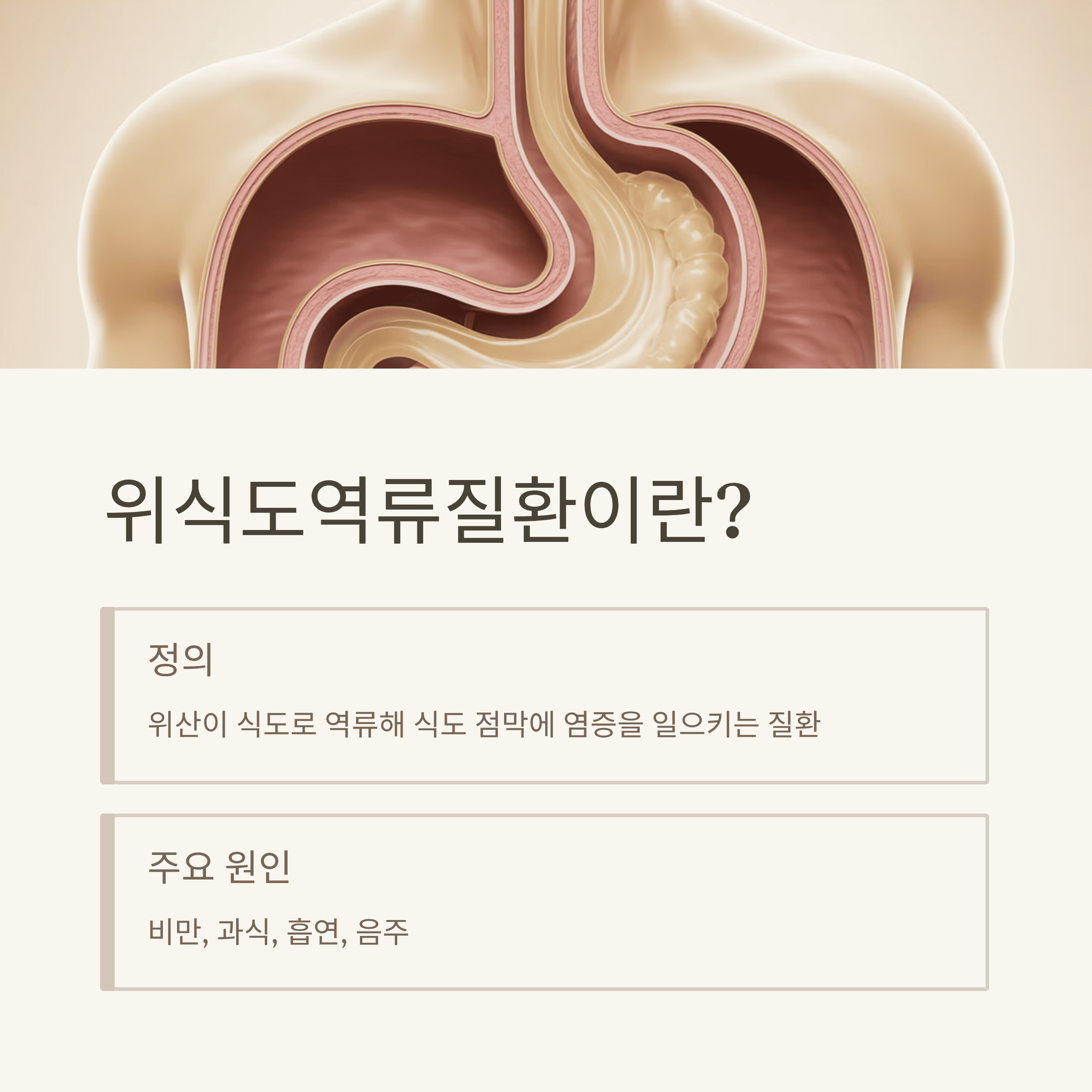 위식도역류질환(GERD) 원인부터 치료까지 핵심 정리