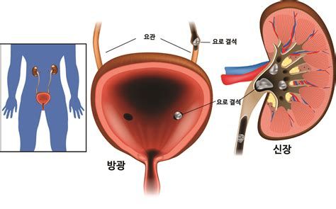 요로 결석 보험