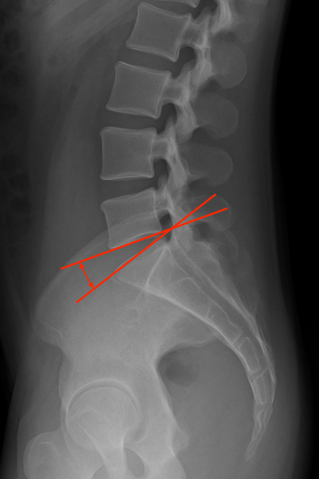 Lumbosacral Disc Angle