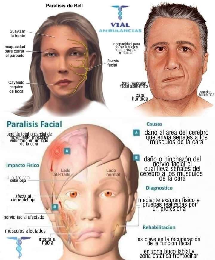 반측성 안면 경련