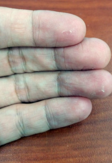 주부습진 합병증