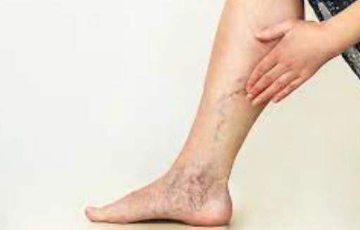 하지정맥류 초기증상