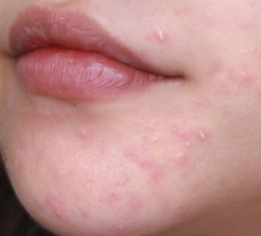 부위별 여드름 원인