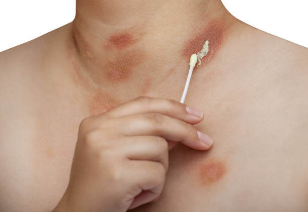 장미색 비강진 원인, 치료, 재발 등에 대해 알아봤습니다. 장미색 비강진은 pityriasis rosea이라고 불리는데요. 어떤 증상과 원인 치료가 있는지 꼼꼼히 읽어보세요!