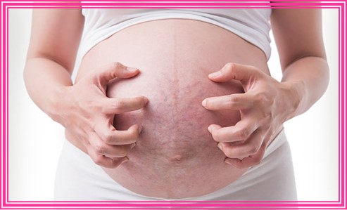 임신 중 알러지 예방 10가지