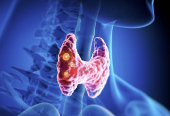 갑상선 기능 저하증 증상 좋은음식 수치 총정리(최신)