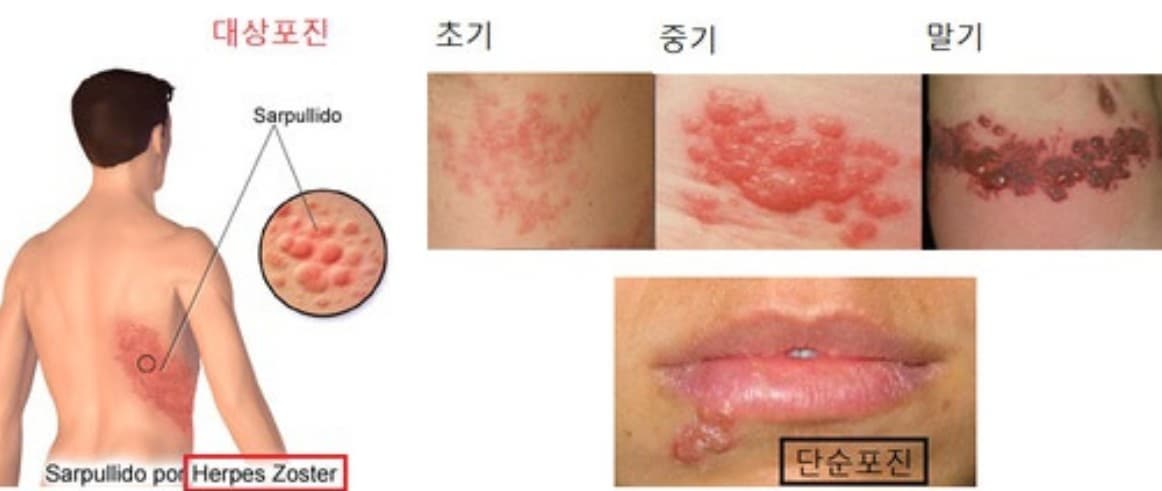 대상포진 단계별 증상과 반드시 확인해야 할 자각 증상에 대한 이미지