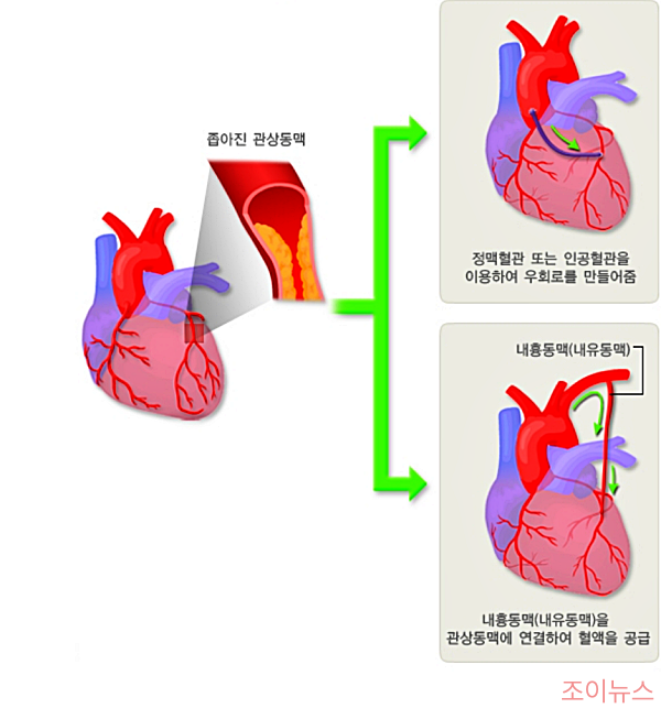 관상동맥 우회술_출처: 국가건강정보포털