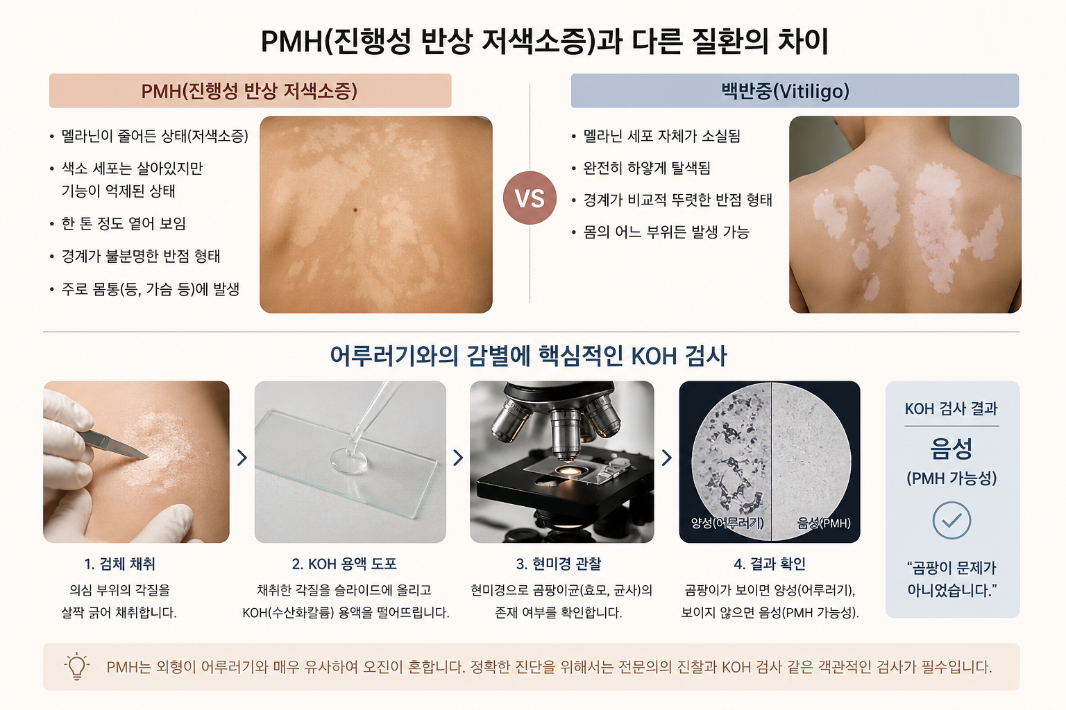 진행성 반상 저색소증 (오진 경험, 광선치료, 감별 진단)