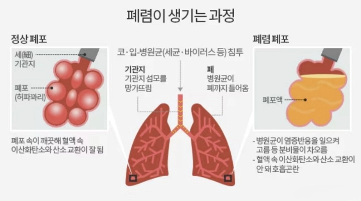 마이코플라즈마 폐렴 증상 원인 단계별 증상 감기 차이점