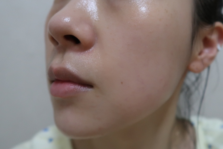 bbl 레이저 후기