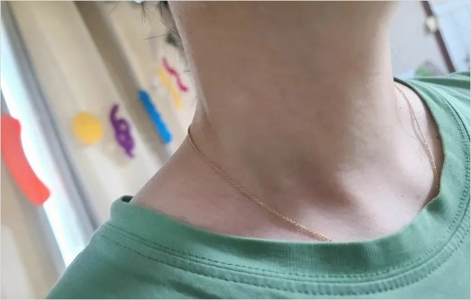 쥐젖 레이저 후