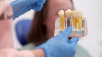 앞니 임플란트 수명