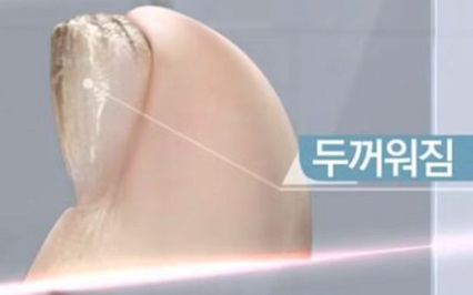 발톱 무좀 없애는 방법
