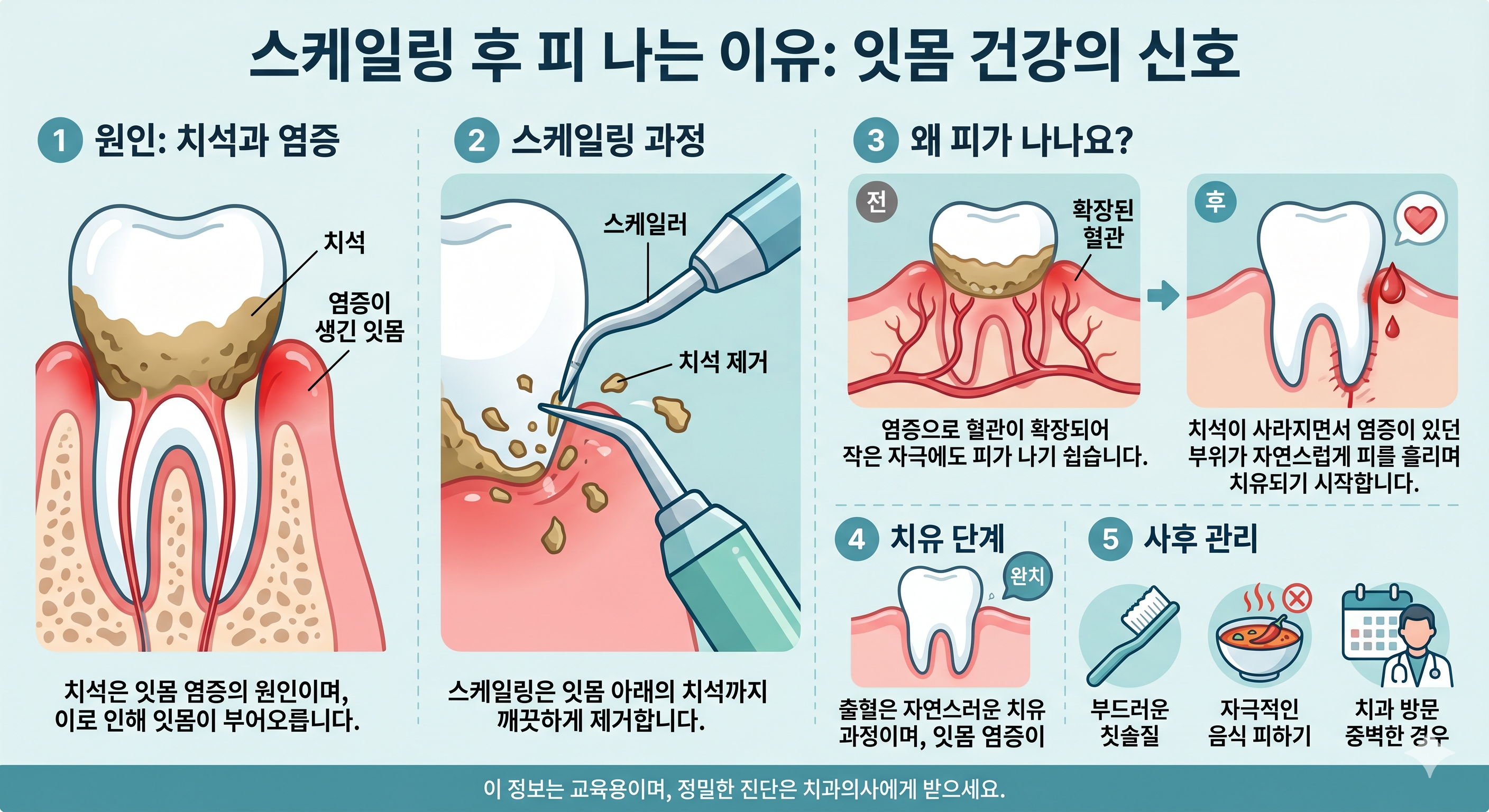 스케일링 후 피 나는 이유와 잇몸 출혈 원인
