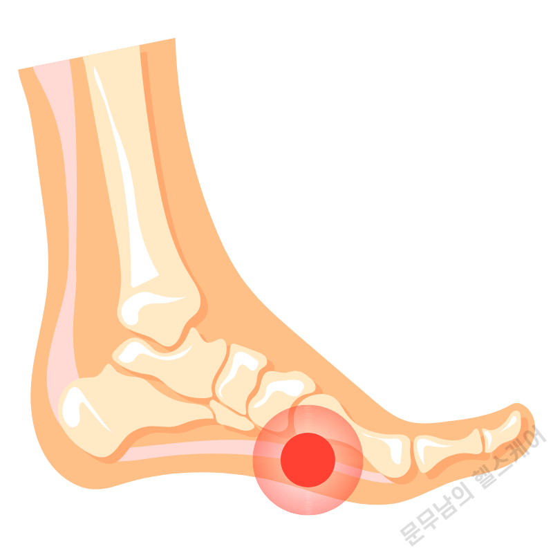 엄지발가락 옆 통증