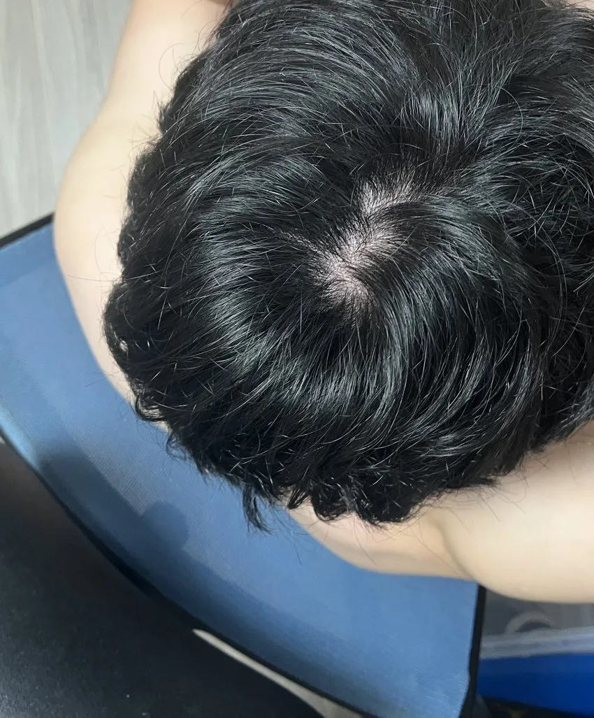 정수리가 아픈 이유와 완화하는 방법_6