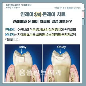 인레이 온레이의 차이와 치료 방법_14