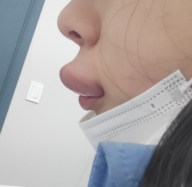 인중 축소 수술 후기