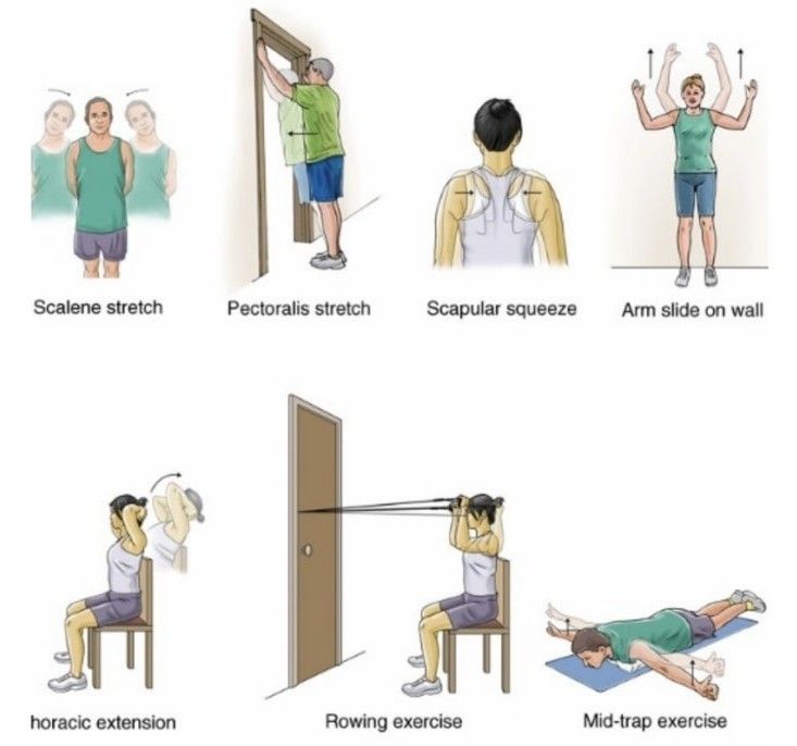 흉곽출구증후군