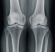 무릎 연골 손상 증상