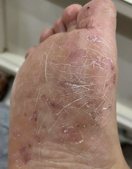 무좀에 감염 관련 사진