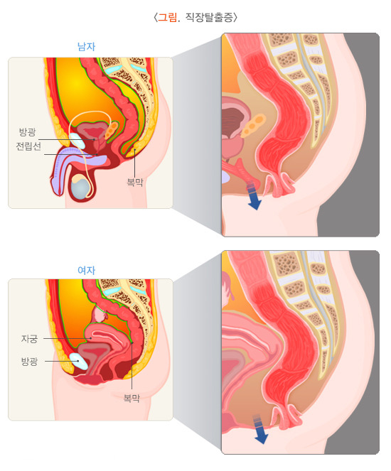 직장탈출증 원인, 증상, 치료방법