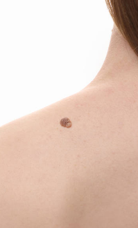 쥐젖 제거방법, 쥐젖이 생기는 이유, 제거 연고 총정리 (2024ver)