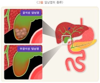 담낭 위치