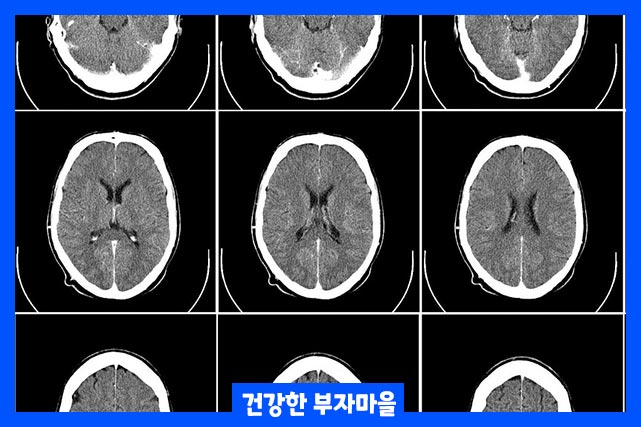 뇌졸중 종류